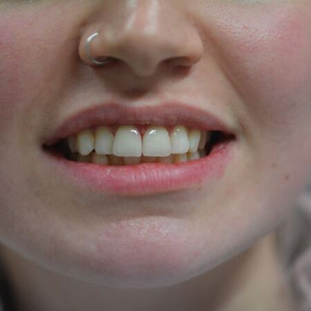 Veneers