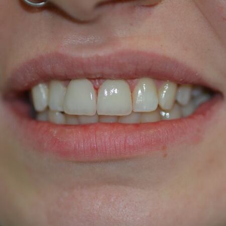Veneers