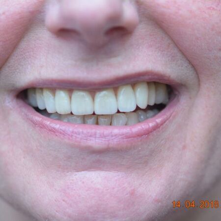 Veneers