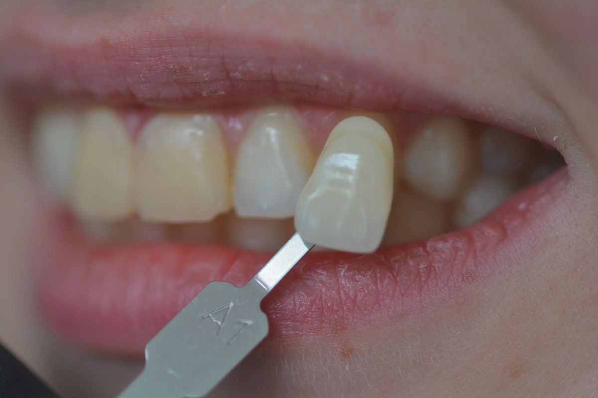 Veneers